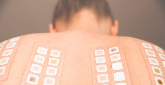 allergy patch testing